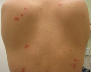 bed bug bites