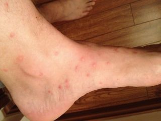 how can i soothe my dogs flea bites