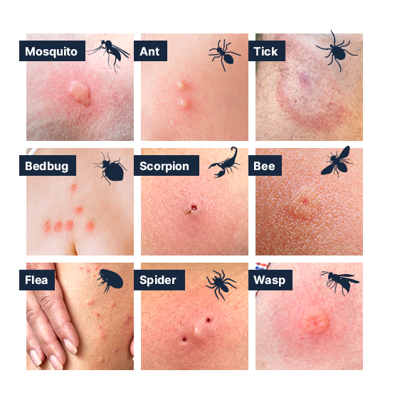 types of pest bites and stings bug bites differences